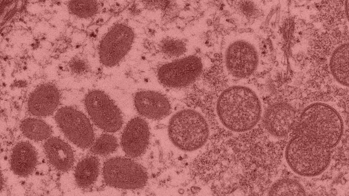 This 2003 electron microscope image made available by the U.S. Centers for Disease Control and Prevention shows the mpox virus obtained from a sample of human skin associated with the 2003 prairie dog outbreak. Here’s what to know about the more severe strain, clade I.