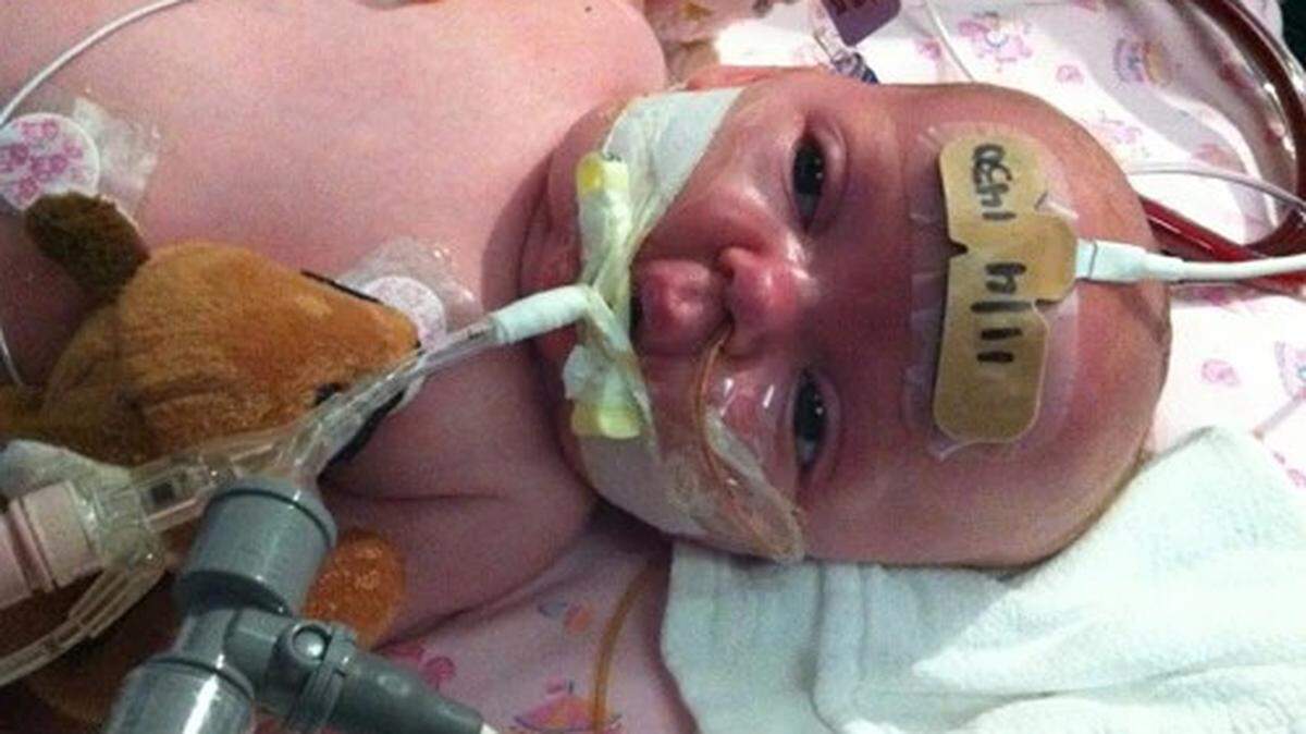 A baby with pertussis (whooping cough) receives treatment in a hospital to aid with breathing. Kootenai County in North Idaho is experiencing an outbreak of pertussis, with 19 cases in the first four months of the year. Meanwhile, Idaho has the lowest rate of vaccination in the nation.