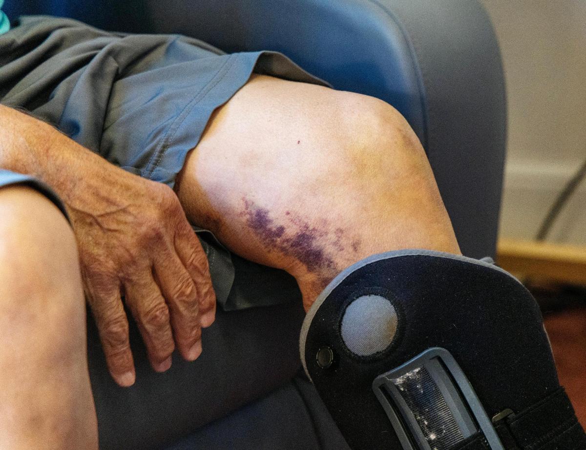 Stephen Allgeier, 73, of Boise, sustained bruises on his leg and arm and a broken foot after he was hit by a vehicle at 11th Street and State streets in July. Now he is dependent on medical transportation for doctors appointments and family to help him with chores.