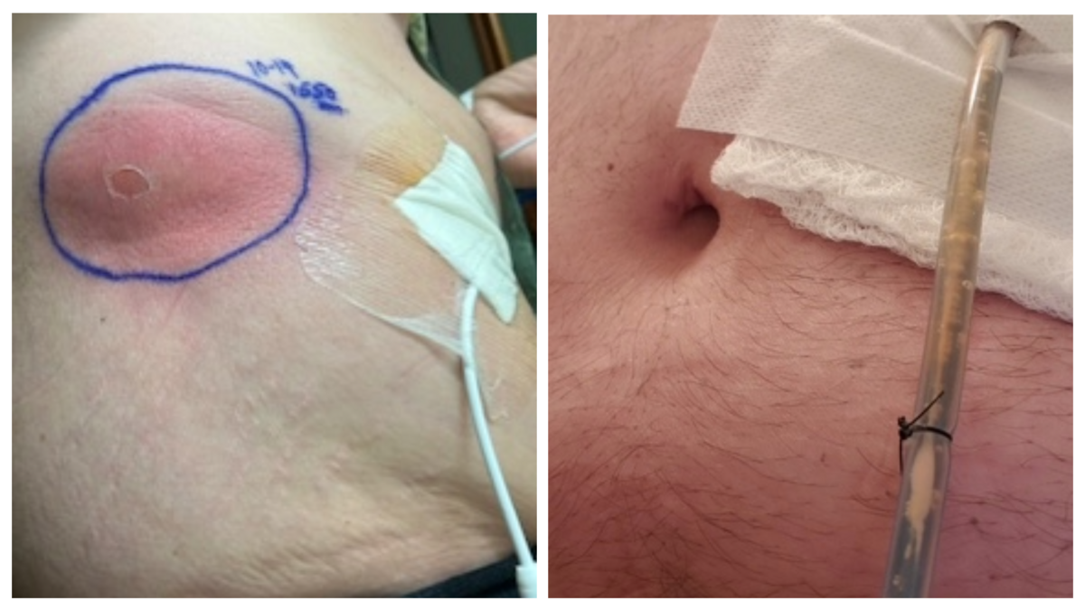 Photos show marker outlining redness on Scott Tighe’s abdomen following an open gallbladder removal surgery, left, and a drain to remove infection.