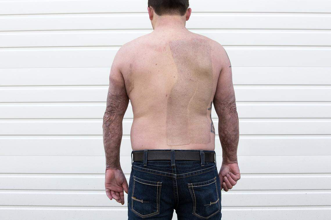 Colby Thompson in Townsend, Montana, grew up driving Polaris vehicles. He was test-driving a friends RZR in 2017 when the vehicle caught fire, and he sustained third-degree burns.