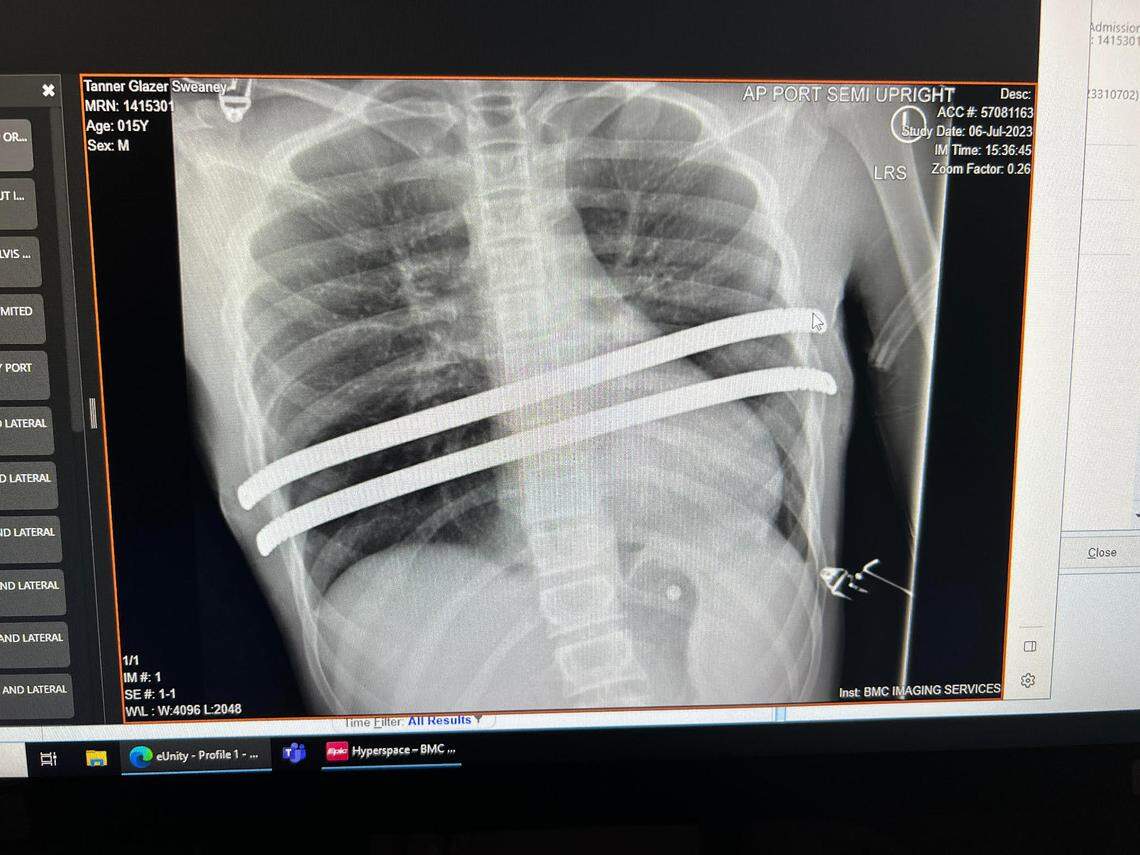 An X-ray shows the metal rods inserted into the chest of Rocky Mountain basketball player Tanner Sweaney, who has a condition known as pectus excavatum.