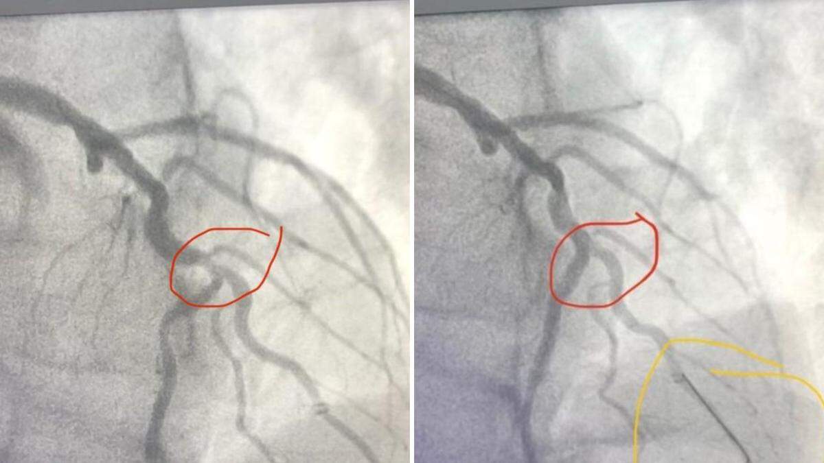 A scan shows Cody Pickett’s clogged artery circled in red before (left) and after (right) having a stent placed at the University of Washington.