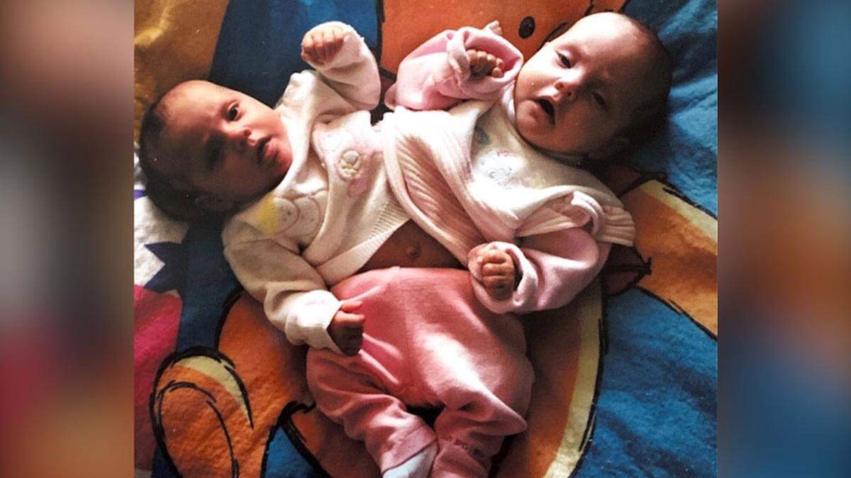 At 36 1/2 weeks, Gabrielle Garcia and her sister, Micheala, were born. The sisters were attached at the hip, and shared a pair of legs and kidneys, a bladder, and intestines.