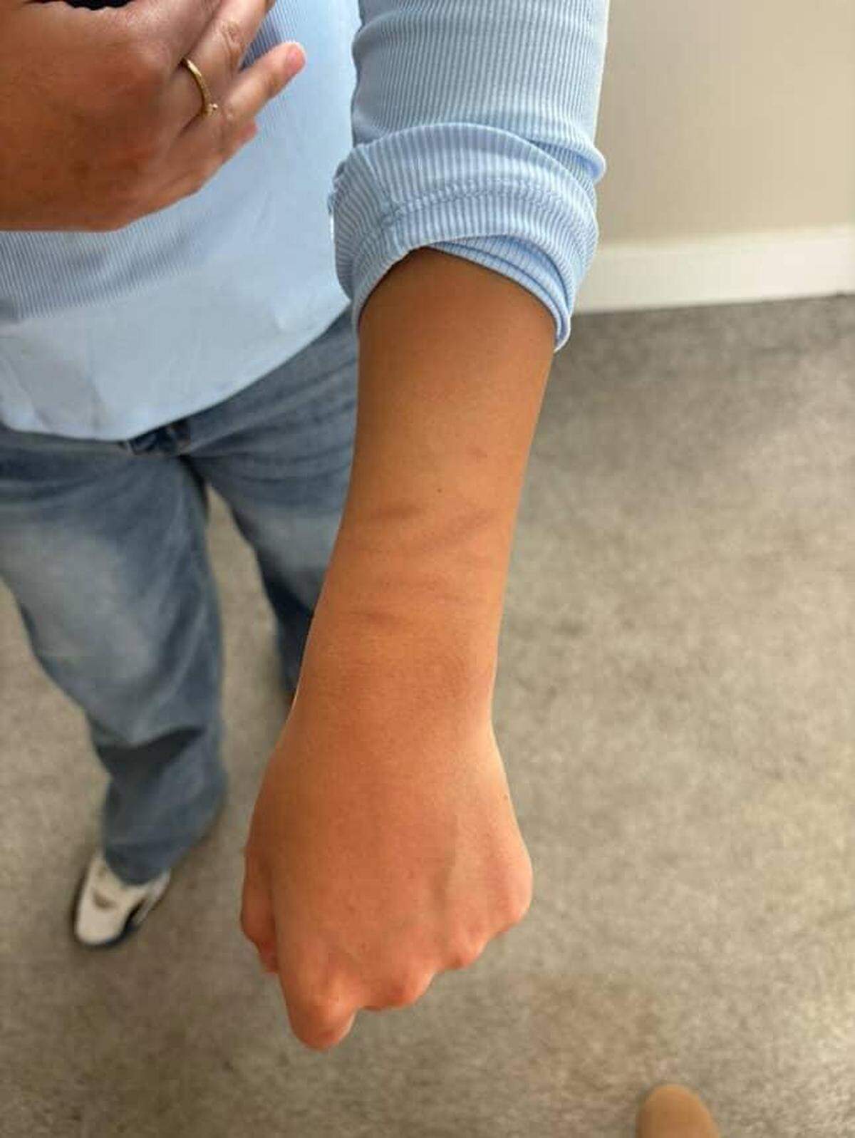 A girl shows off marks left behind by zip-ties at the October raid in Wilder where hundreds of people were initially detained, including children.