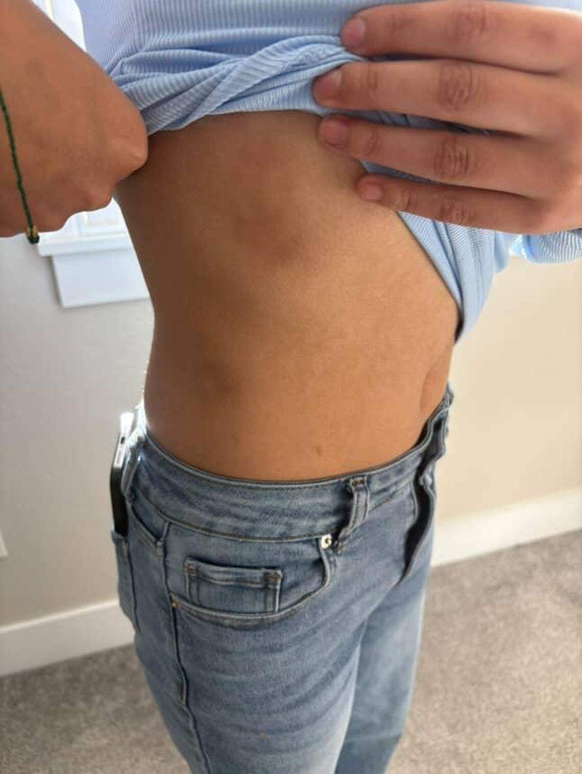 SueHey Tello, 14, shows bruises she said she obtained when officers pulled her from her mother’s truck, causing her to fall to the ground.