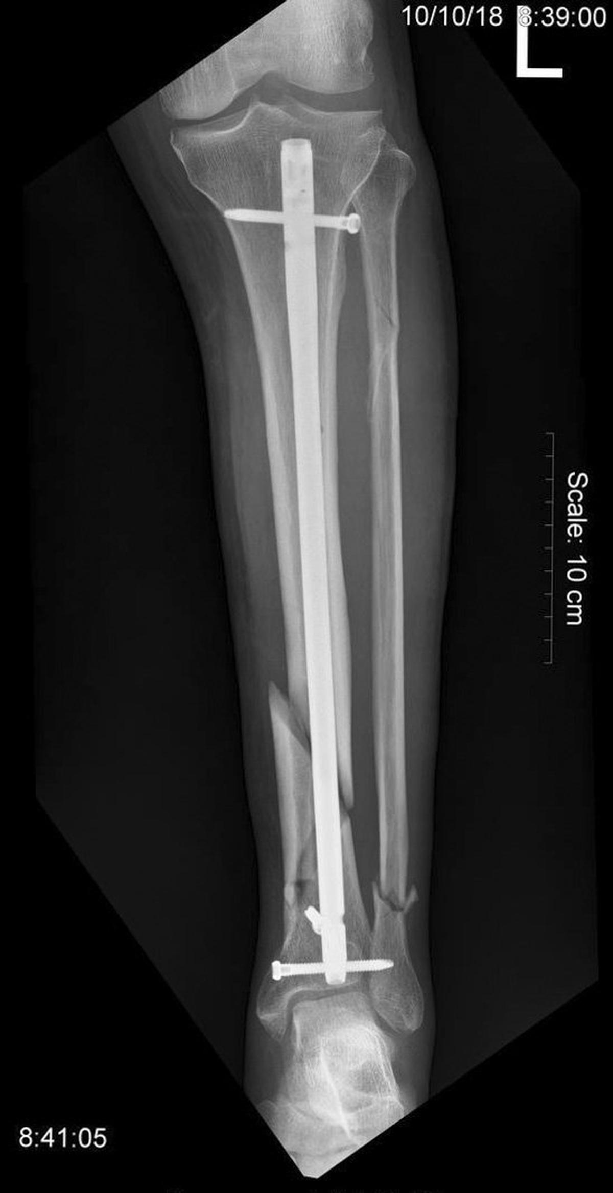 Dick Ross broke both legs. His left leg now sports this titanium rod running through the middle of his tibia.