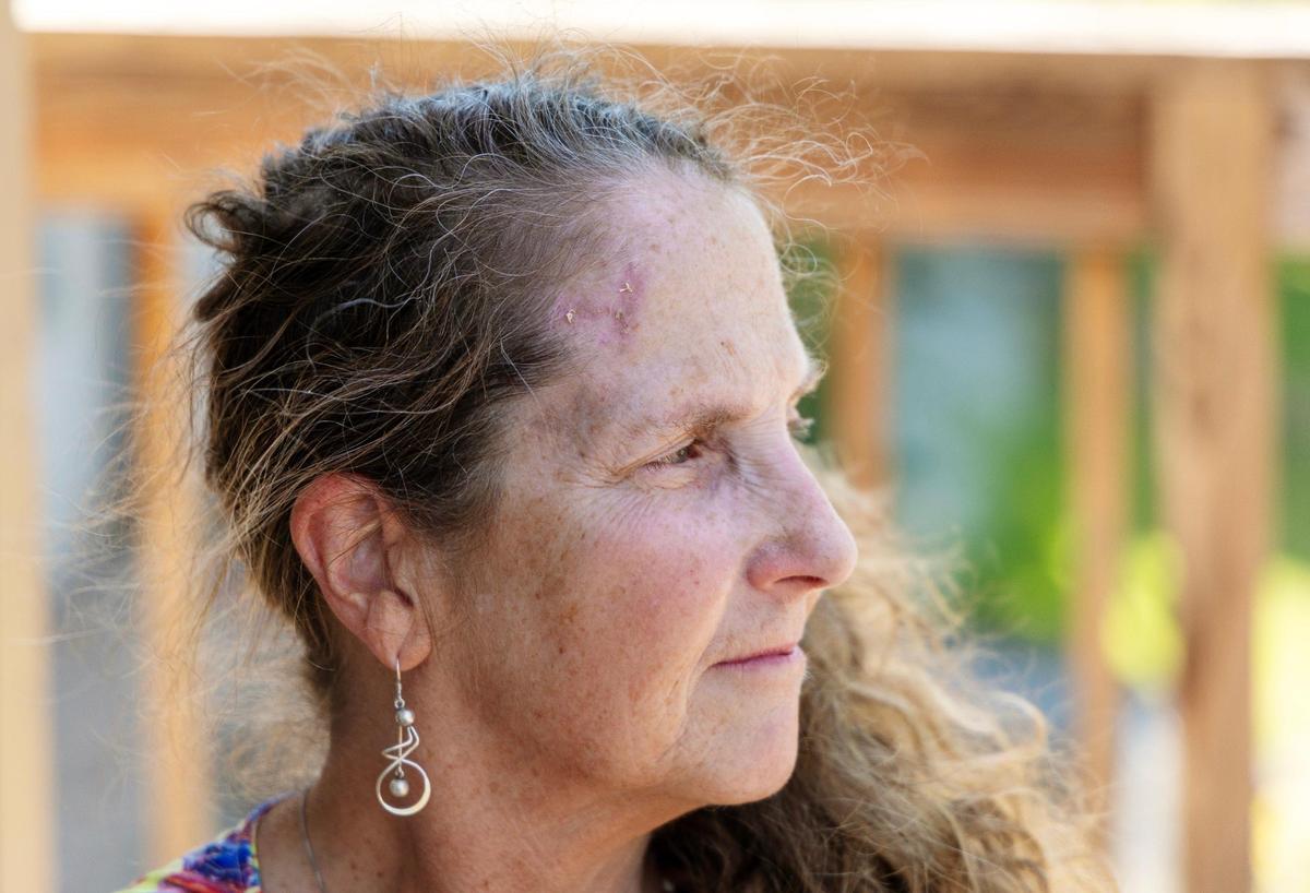 The spot where Bridget Anderson, 63, of Boise, had stitches on her forehead is visible after weeks of recovery. She was injured by a vehicle while in the crosswalk of State Street at 11th Street to go to the Downtown Boise YMCA.