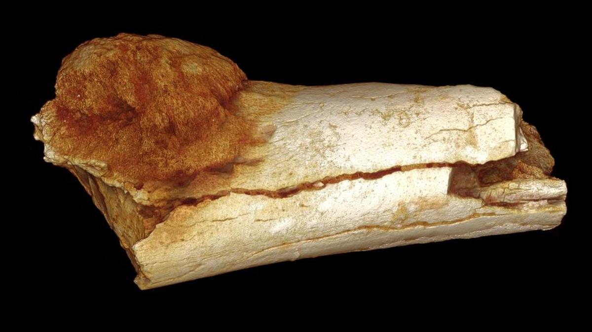 3-D imaging helped make clear a cancerous growth on this 1.7 million year-old fossil.