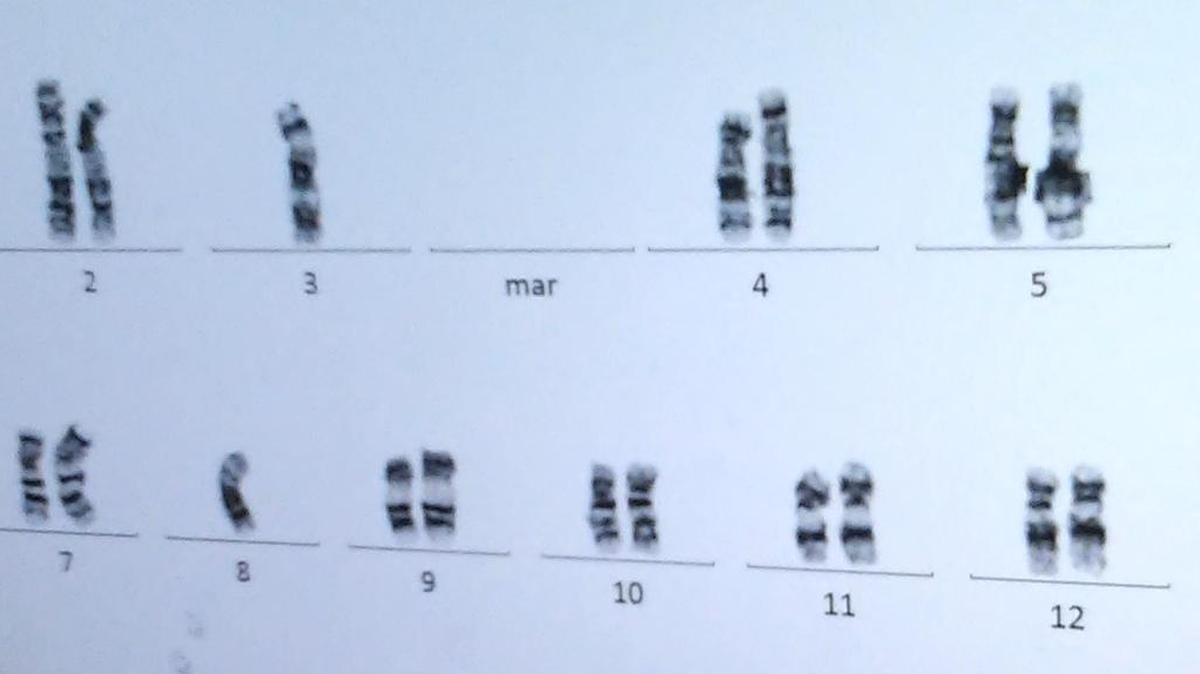 These chromosome images are part of a generic set that Idaho Cytogenetics Diagnostic Laboratory uses for training. They do not belong to a local patient.