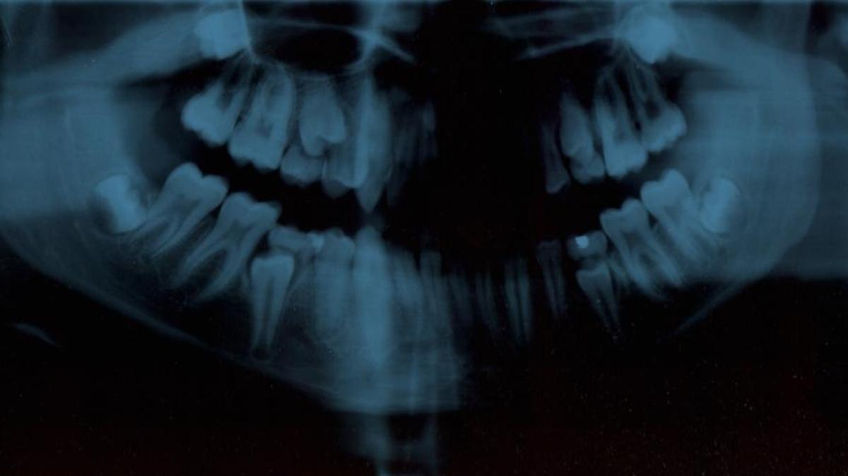 The Idaho Board of Dentistry says Accure Dental & Dentures in Meridian closed without notifying patients or giving them medical records. Dentist and business owner Tera Greene is accused of patient abandonment. (Pictured: A tooth X-ray.)