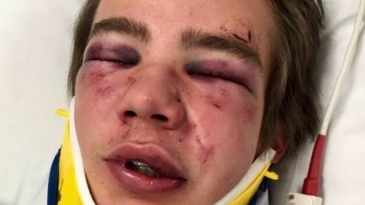 Boise State freshman Ben Taylor, seen here in the hospital, claims he was beaten by Boise State football player Jace Richter.