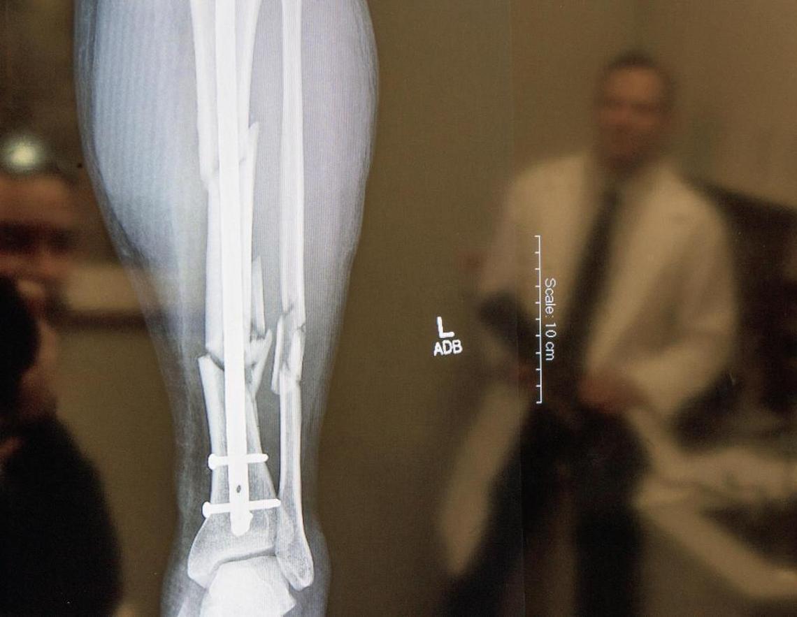 Jamie Harrell visits Dr. Darin Jurgensmeier on his final exam at the Saint Alphonsus Joint Preservation and Reconstruction offices in Boise. Dr. Jurgensmeier shows an X-ray of multiple breaks in Harrell’s leg.