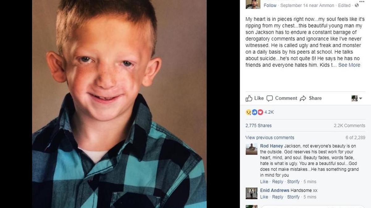 Dan Bezzant wrote this post about his son, Jackson, after the boy was bullied at school for his appearance. Jackson has Treacher Collins syndrome.