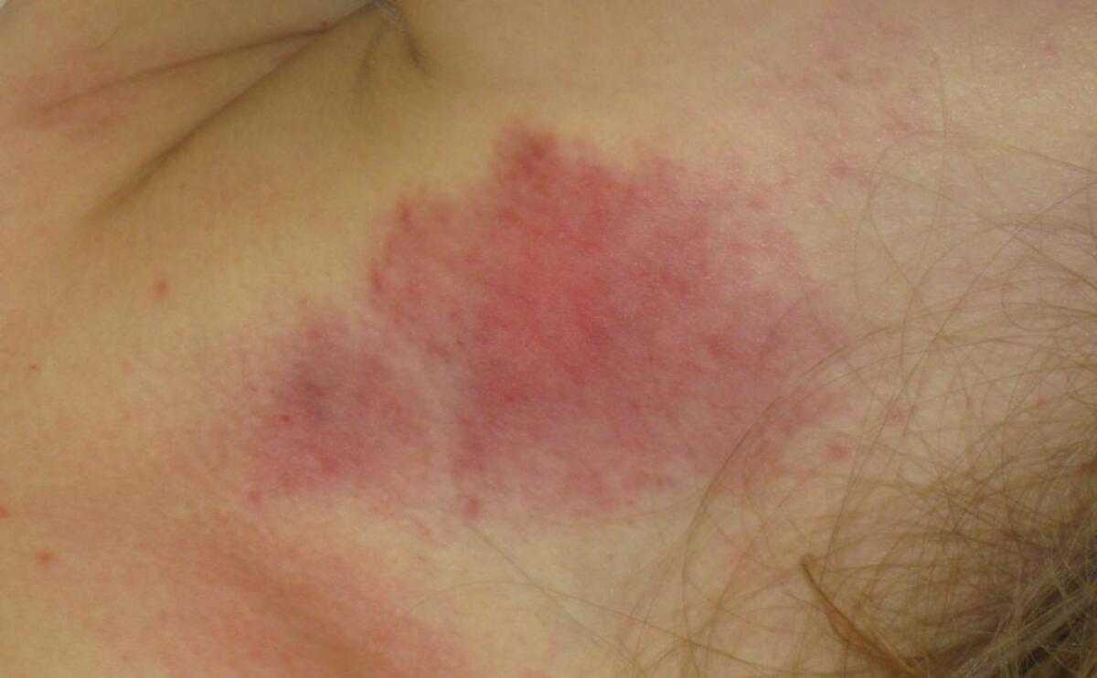 This is an example of the neck bruising the woman sustained in the November 2012 incident.