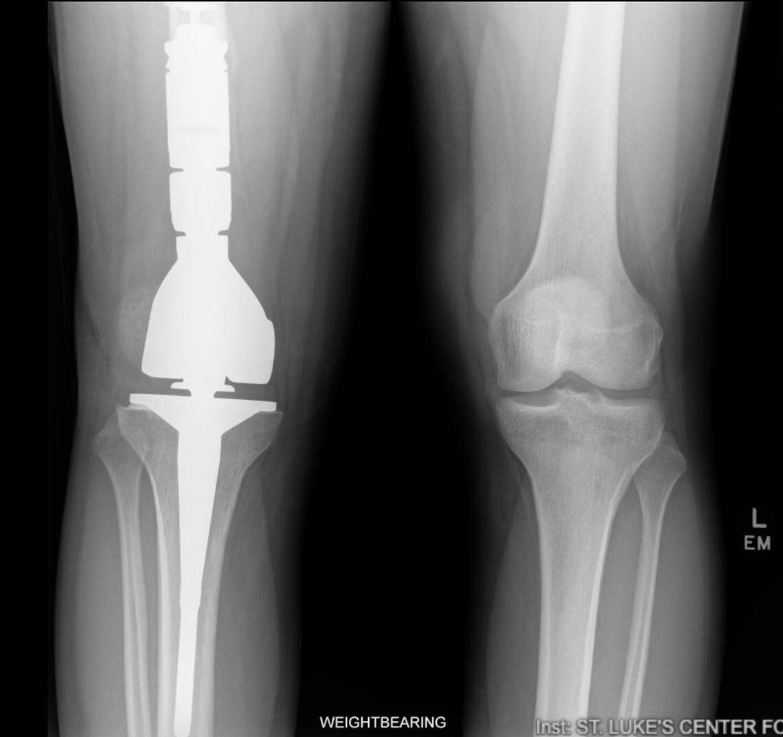 An x-ray shows Eli Parker’s knee implant three months after surgery.