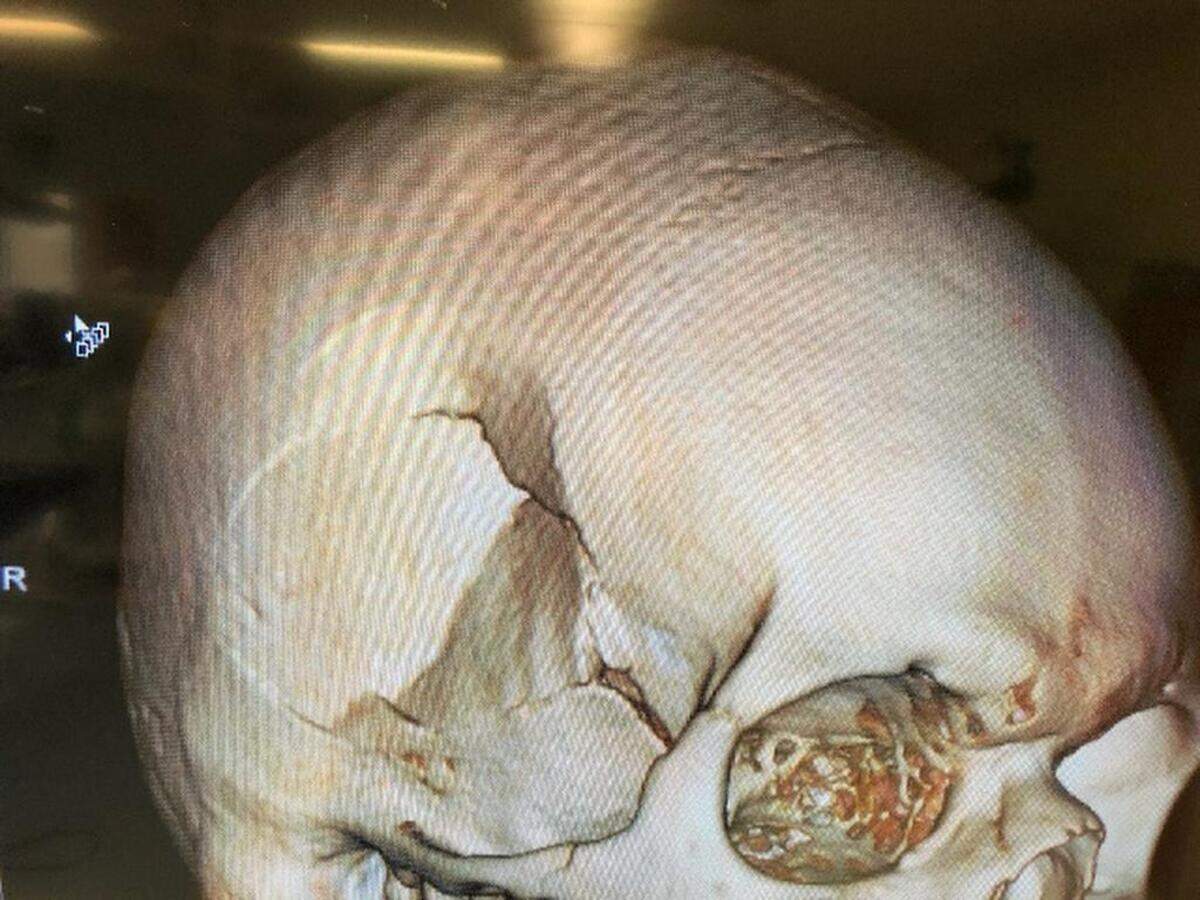 A 3D image shows the damage to the skull of the freshman.